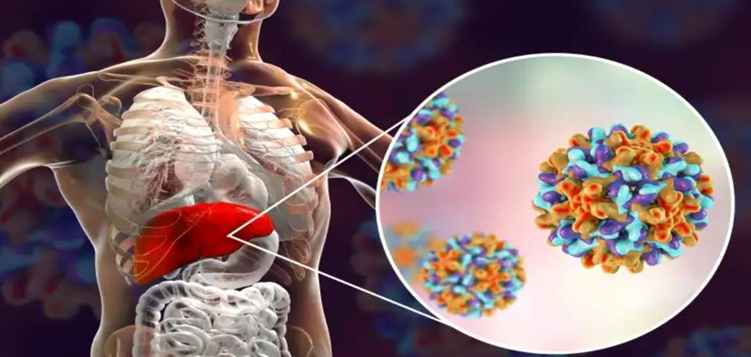 Waspada. IDAI Siapkan Protokol Antisipasi Hepatitis Akut Meluas Waspada. IDAI Siapkan Protokol Antisipasi Hepatitis Akut Meluas